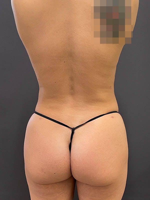 Patient 5 Female Liposuction Before & After