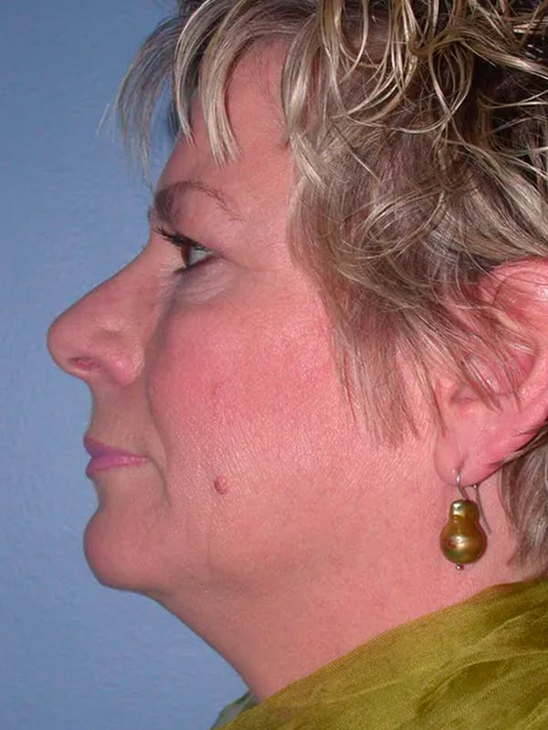 Brow Lift Gallery Before & After Gallery - Patient 4756900 - Image 5