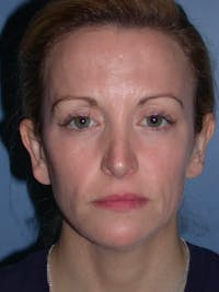 Facial Fat Grafting Before & After Gallery - Patient 5900845 - Image 1