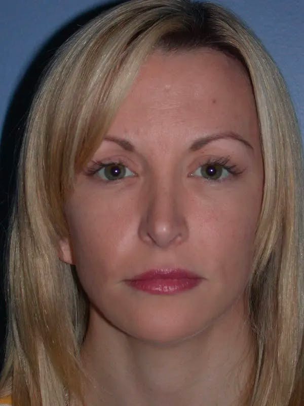 Brow Lift Gallery Before & After Gallery - Patient 5900586 - Image 2