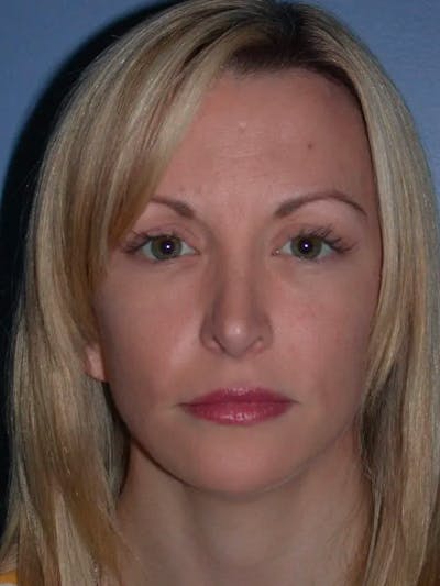 Brow Lift Before & After Gallery - Patient 5900586 - Image 2
