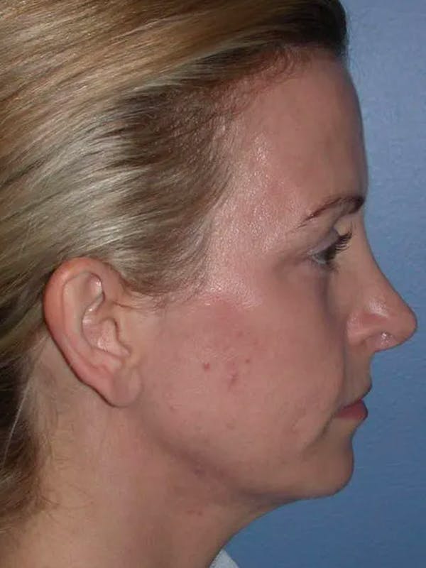 Eyelid Lift Before & After Gallery - Patient 4756907 - Image 3