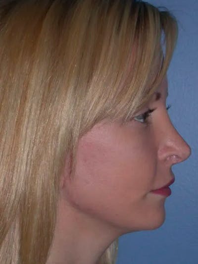 Brow Lift Gallery Before & After Gallery - Patient 5900586 - Image 4