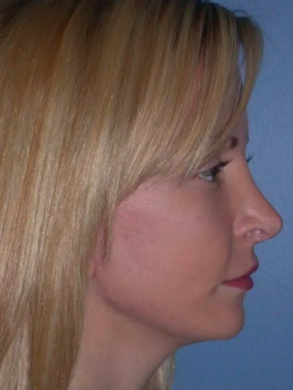 Facelift Gallery Before & After Gallery - Patient 4756941 - Image 4