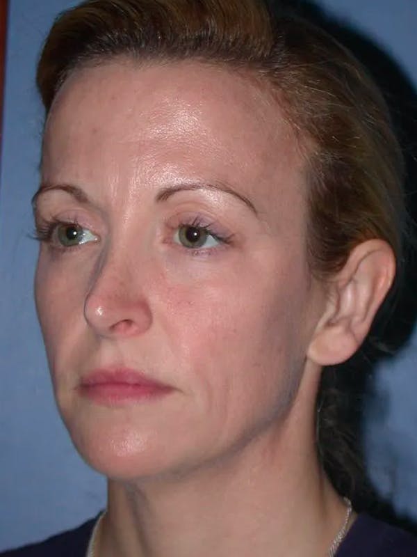 Facial Fat Grafting Gallery Before & After Gallery - Patient 5900845 - Image 5