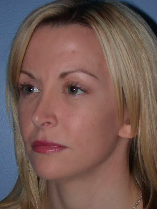 Facial Fat Grafting Gallery Before & After Gallery - Patient 5900845 - Image 6