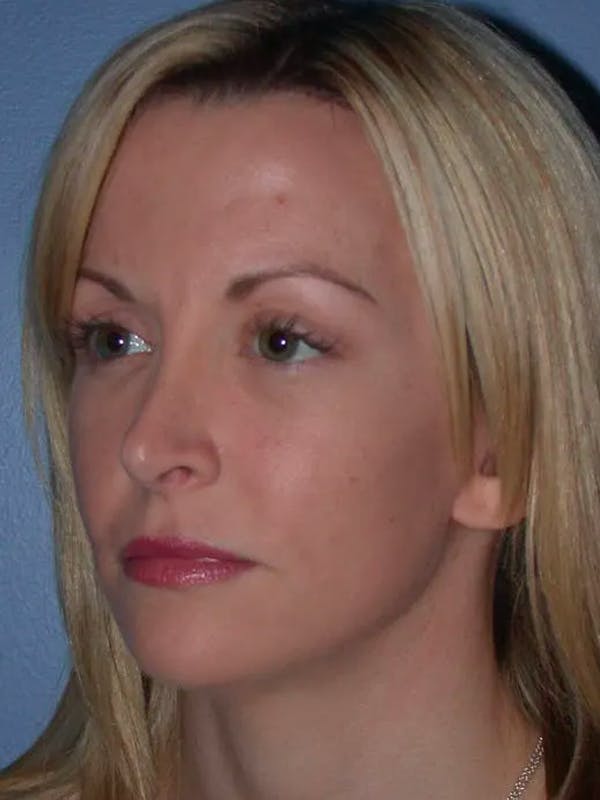 Facelift Gallery Before & After Gallery - Patient 4756941 - Image 6