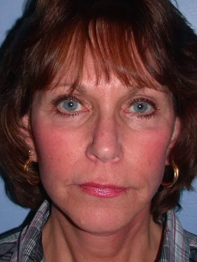 Facelift Before & After Gallery - Patient 4756948 - Image 2