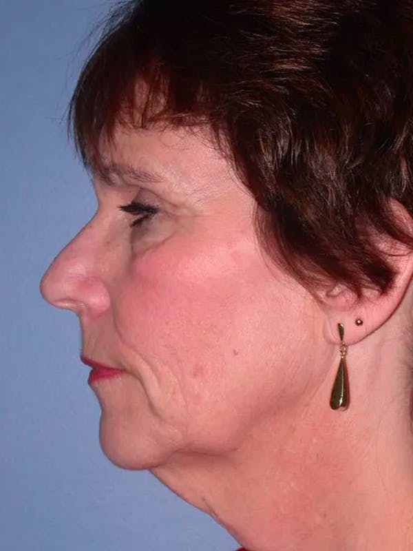 Facelift Gallery Before & After Gallery - Patient 4756948 - Image 3