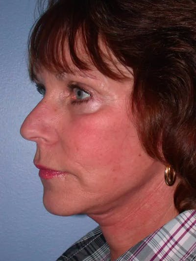 Brow Lift Gallery Before & After Gallery - Patient 5900587 - Image 4