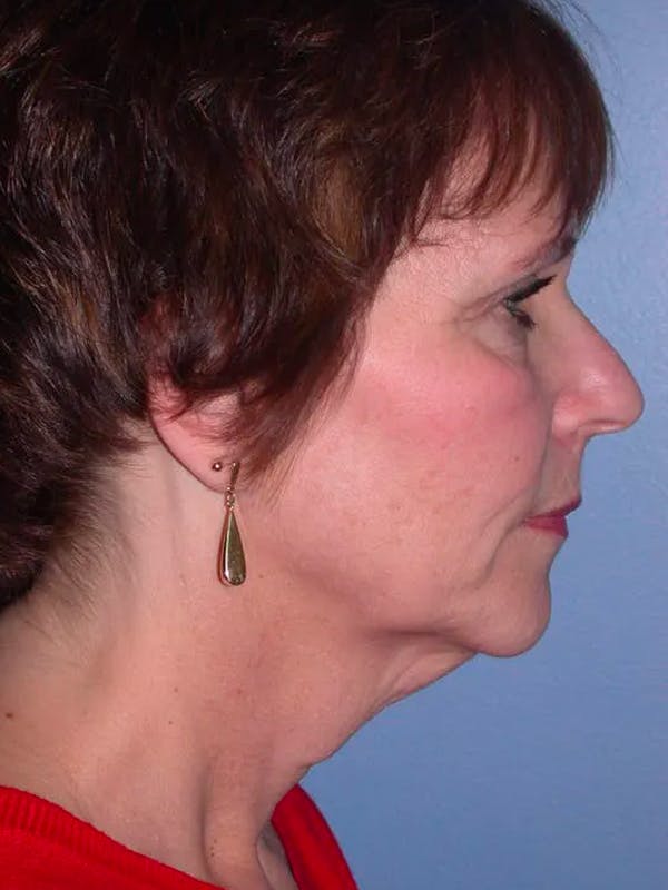 Brow Lift Gallery Before & After Gallery - Patient 5900587 - Image 5