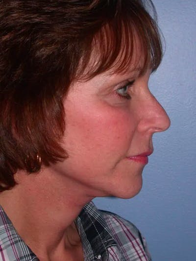 Brow Lift Gallery Before & After Gallery - Patient 5900587 - Image 6