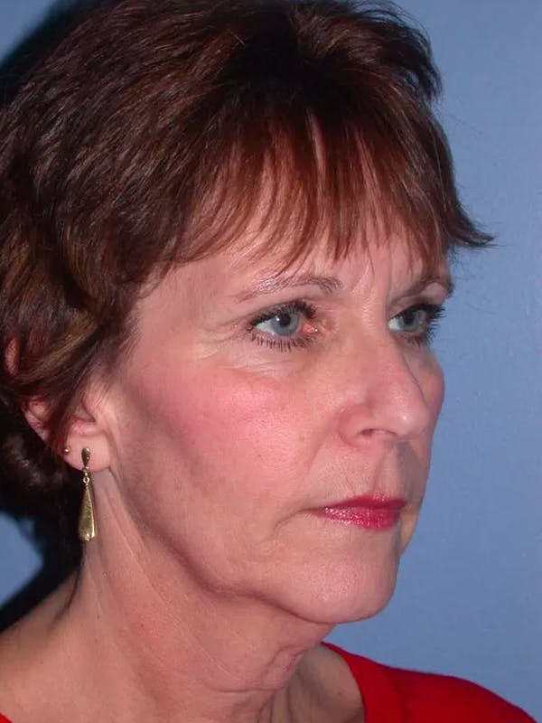 Facelift Gallery Before & After Gallery - Patient 4756948 - Image 7