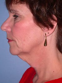 Neck Lift Gallery Before & After Gallery - Patient 4757151 - Image 1