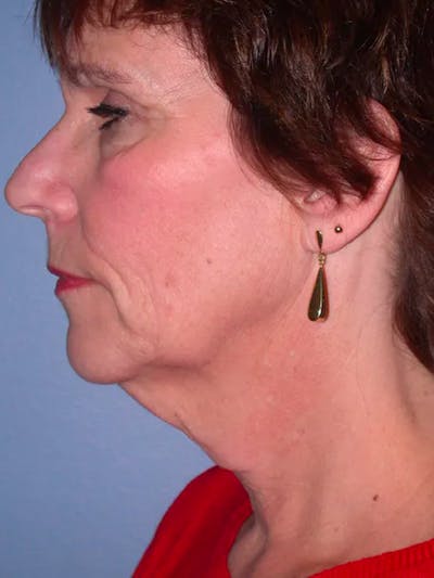 Neck Lift Gallery Before & After Gallery - Patient 4757151 - Image 1