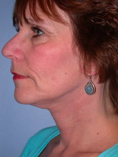 Neck Lift Gallery Before & After Gallery - Patient 4757151 - Image 2