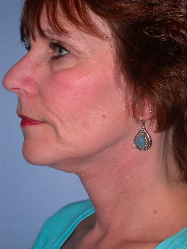 Neck Lift Before & After Gallery - Patient 4757151 - Image 2