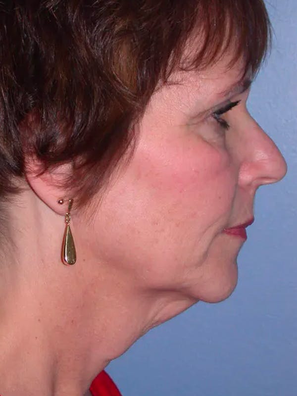 Neck Lift Gallery Before & After Gallery - Patient 4757151 - Image 3