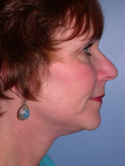 Neck Lift Gallery Before & After Gallery - Patient 4757151 - Image 4