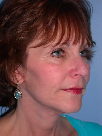 Neck Lift Gallery Before & After Gallery - Patient 4757151 - Image 6