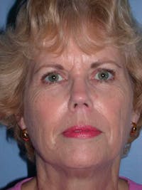 Facelift Before & After Gallery - Patient 4757000 - Image 1