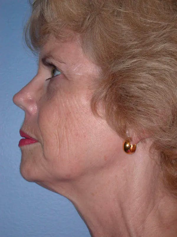 Brow Lift Before & After Gallery - Patient 5900588 - Image 3