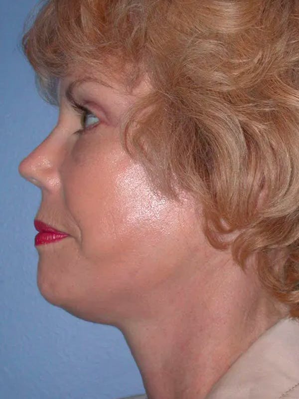 Facelift Before & After Gallery - Patient 4757000 - Image 4