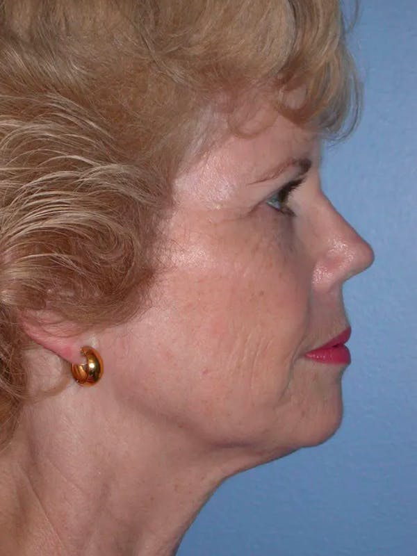 Brow Lift Gallery Before & After Gallery - Patient 5900588 - Image 5
