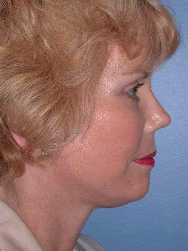 Facelift Gallery Before & After Gallery - Patient 4757000 - Image 6