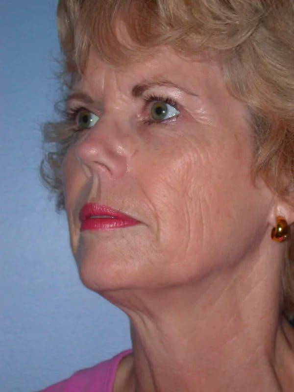 Facelift Gallery Before & After Gallery - Patient 4757000 - Image 7