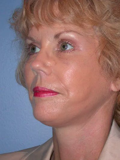 Facelift Gallery Before & After Gallery - Patient 4757000 - Image 8