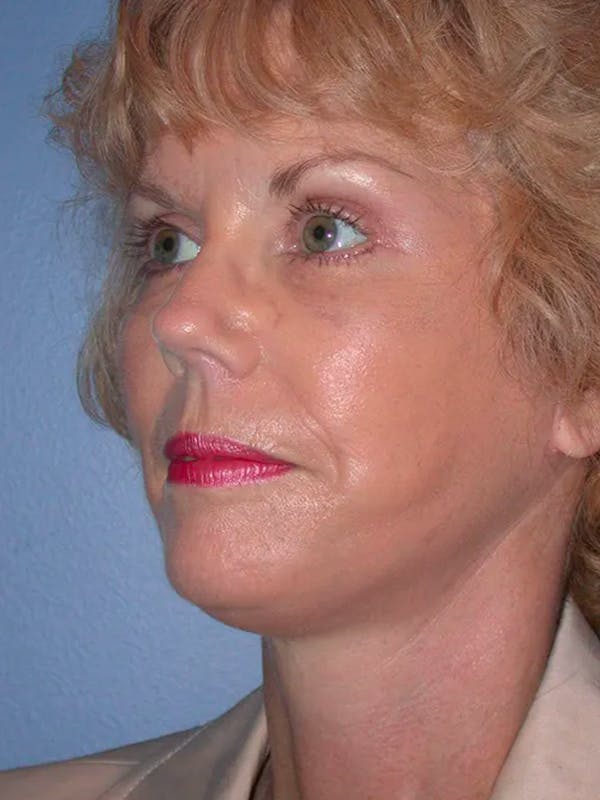 Facelift Before & After Gallery - Patient 4757000 - Image 8