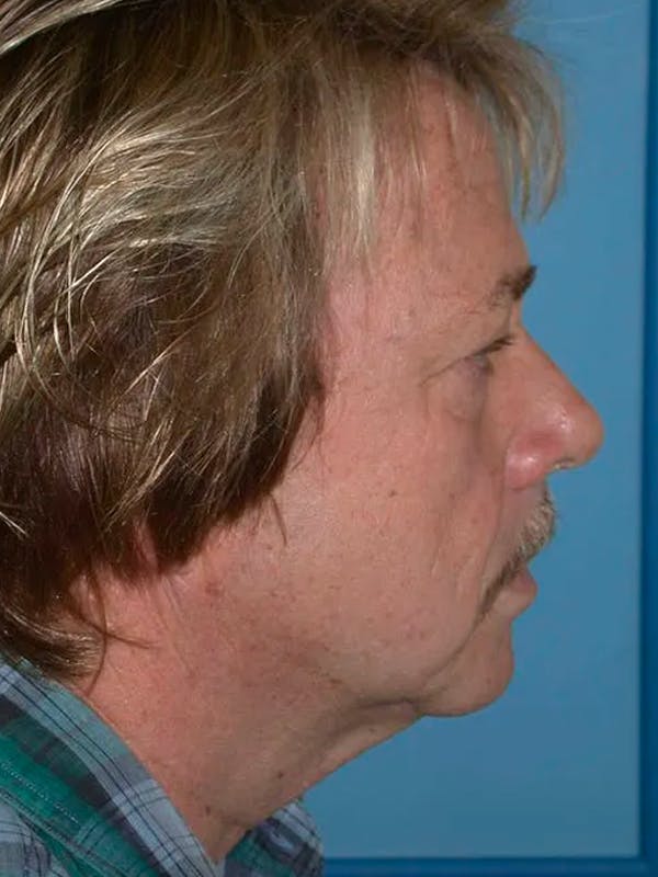 Neck Lift Before & After Gallery - Patient 5069549 - Image 3