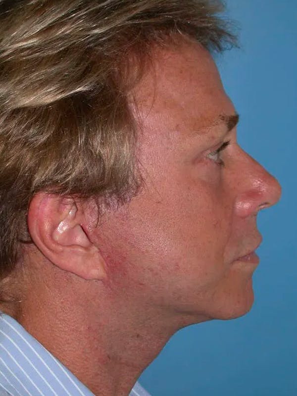 Facelift Before & After Gallery - Patient 4757009 - Image 4