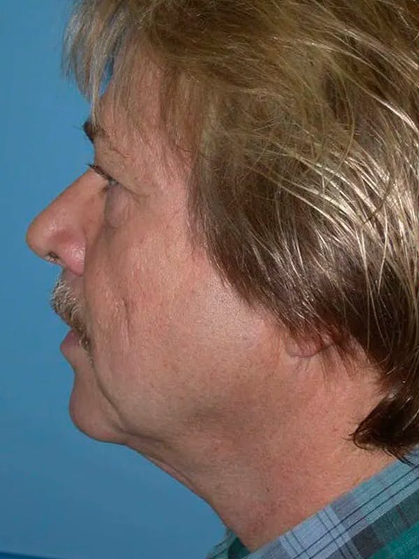 Neck Lift Gallery Before & After Gallery - Patient 5069549 - Image 5