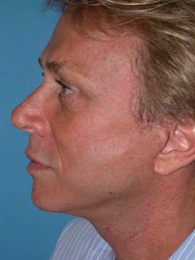 Neck Lift Gallery Before & After Gallery - Patient 5069549 - Image 6