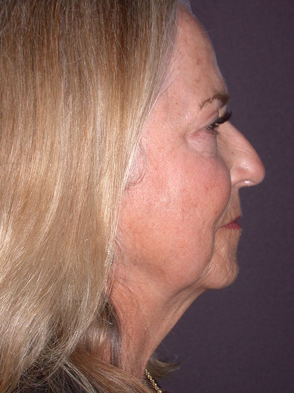 Neck Lift Gallery Before & After Gallery - Patient 69593586 - Image 7