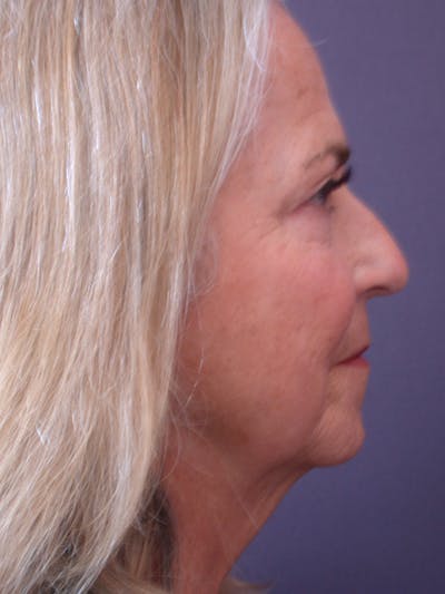 Neck Lift Before & After Gallery - Patient 69593586 - Image 8