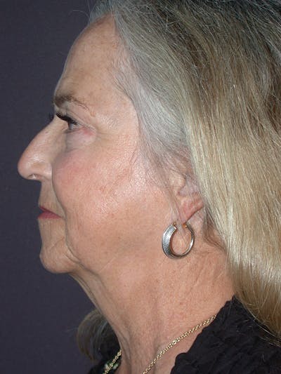 Neck Lift Before & After Gallery - Patient 69593586 - Image 1