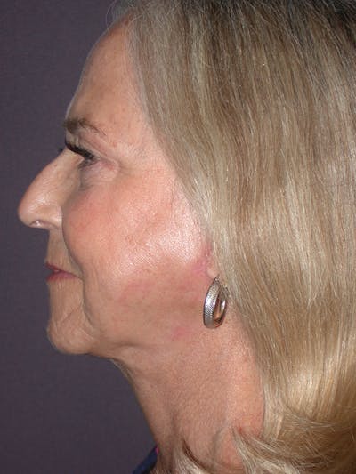 Neck Lift Gallery Before & After Gallery - Patient 69593586 - Image 2