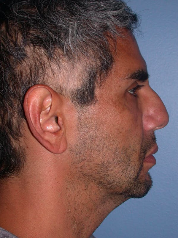 Facial Fat Grafting Gallery Before & After Gallery - Patient 4757168 - Image 5