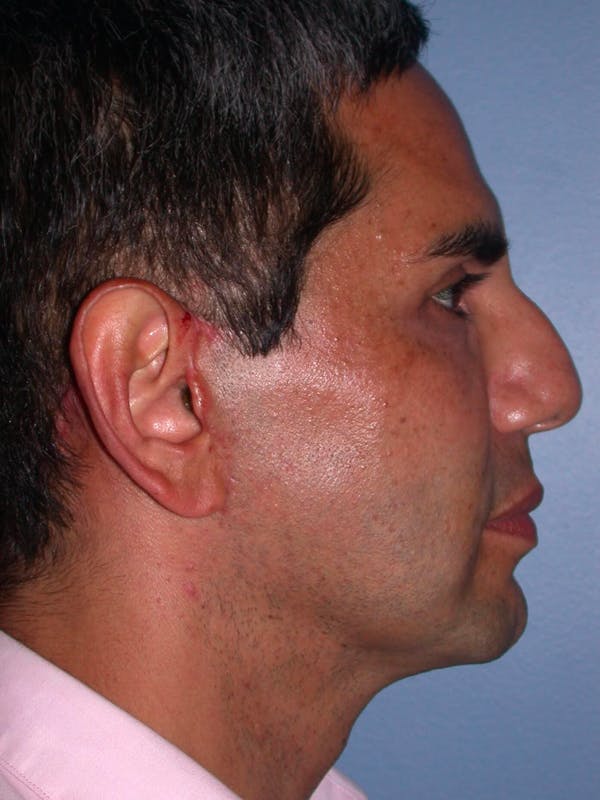 Cheek Lift Before & After Gallery - Patient 4756903 - Image 6