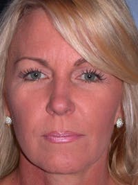 Facelift Before & After Gallery - Patient 4756967 - Image 1