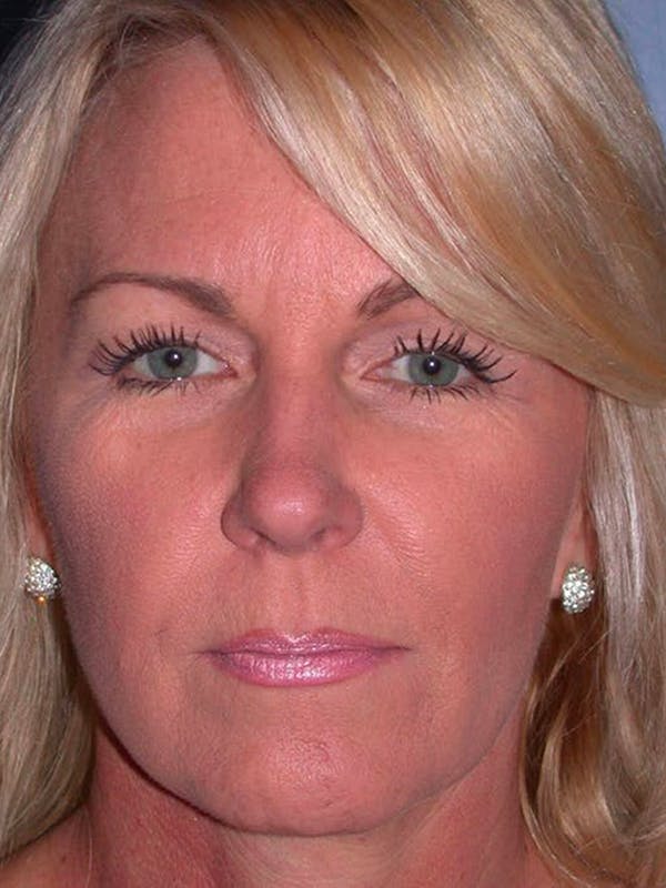 Facelift Before & After Gallery - Patient 4756967 - Image 1