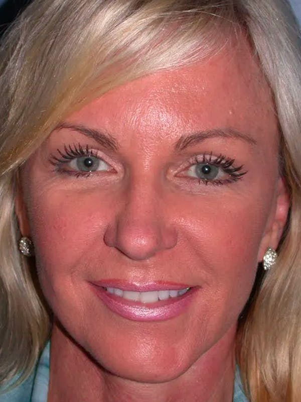 Facelift Gallery Before & After Gallery - Patient 4756967 - Image 2