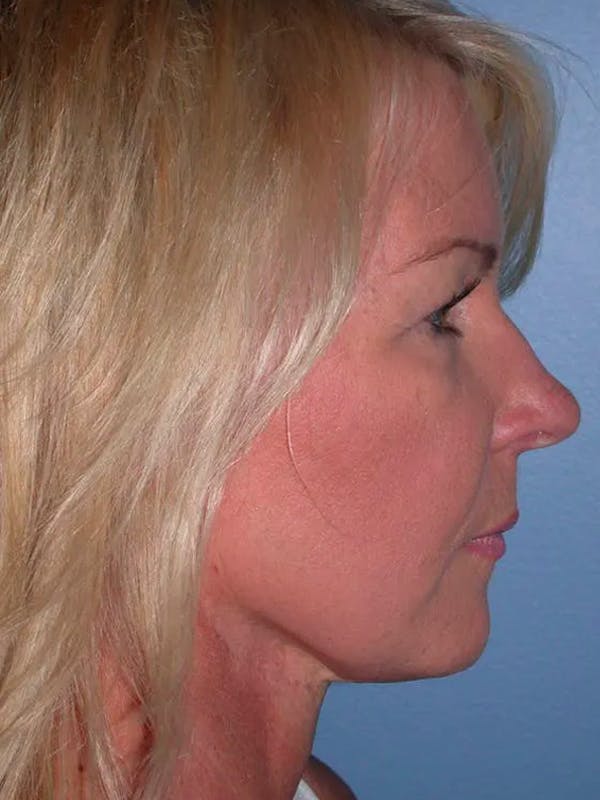Facelift Gallery Before & After Gallery - Patient 4756967 - Image 3