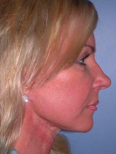 Cheek Lift Gallery Before & After Gallery - Patient 5900606 - Image 4