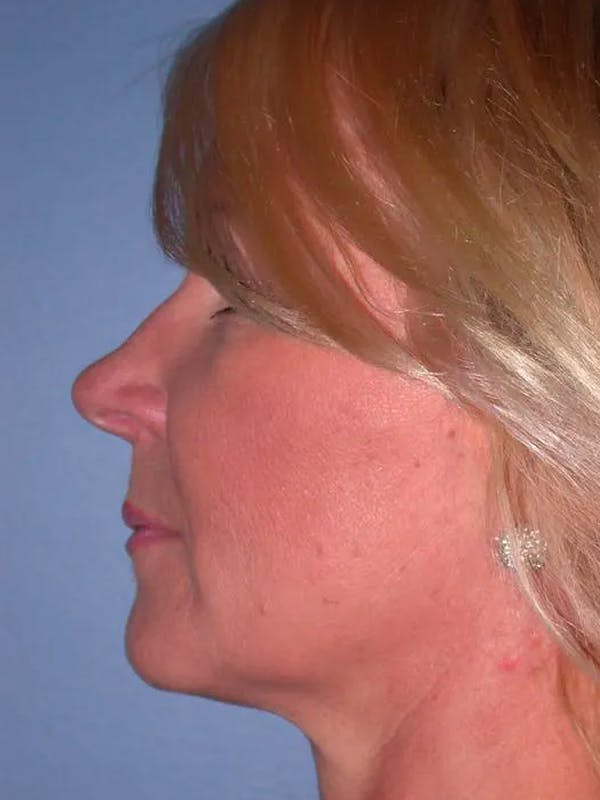 Facelift Gallery Before & After Gallery - Patient 4756967 - Image 5