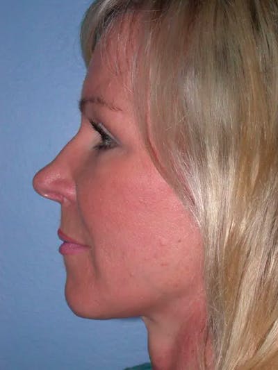 Cheek Lift Gallery Before & After Gallery - Patient 5900606 - Image 6