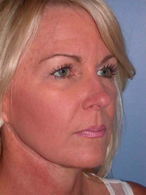 Cheek Lift Gallery Before & After Gallery - Patient 5900606 - Image 7